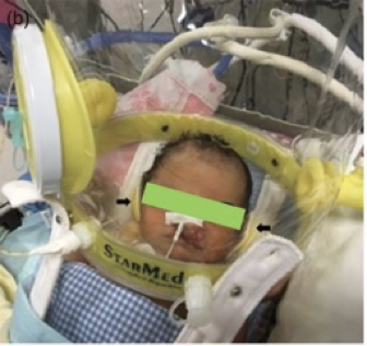 Case Report: Supporto respiratorio con casco in un neonato con grave malformazione facciale